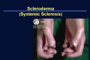 Scleroderma Systemic Sclerosis Definition Systemic sclerosis scleroderma a
