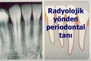 Radyolojik ynden periodontal tan Periodontal hastaln karakteristik belirti