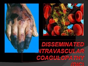 Disseminated intravascular coagulation pathophysiology