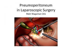 Pneumoperitoneum in Laparoscopic Surgery Matt Wagaman CA 1