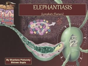 ELEPHANTIASIS Lymphatic filariasis By Shantanu Pisharoty Shireen Gupta