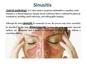 Sinusitis Antral pathology It is often mimics symptoms