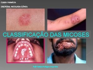 CURSO FARMCIA DISCIPLINA MICOLOGIA CLNICA CLASSIFICAO DAS MICOSES