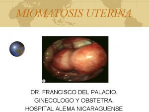 MIOMATOSIS UTERINA DR FRANCISCO DEL PALACIO GINECOLOGO Y