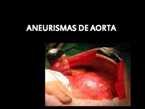 ANEURISMAS DE AORTA INTRODUCCIN Dilatacin permanente de la