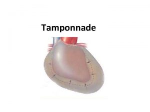 Tamponnade Signes cliniques Tamponnade Tachycardie Signes dinsuffisance cardiaque