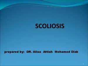 SCOLIOSIS prepared by DR Aliaa Attiah Mohamed Diab