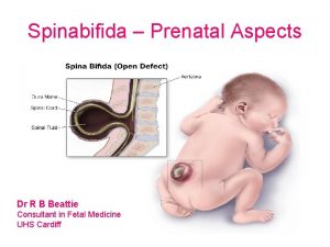 Spinabifida Prenatal Aspects Dr R B Beattie Consultant