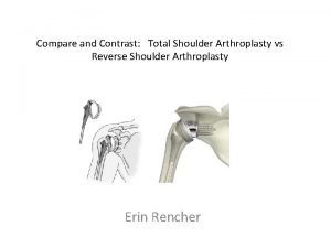 Compare and Contrast Total Shoulder Arthroplasty vs Reverse