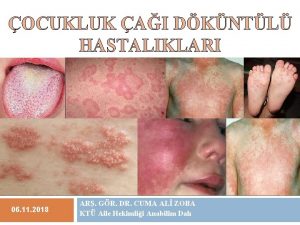 Atopik dermatit major kriterler