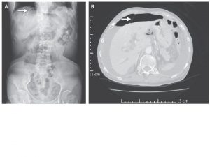 An 87 yearold woman hypertension and peptic ulcer