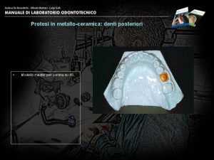 Protesi in metalloceramica denti posteriori Modello master per