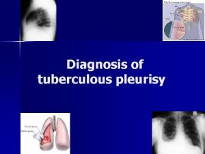 Diagnosis of tuberculous pleurisy Clinical diagnosis v v