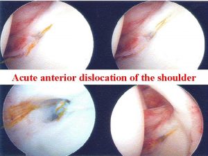 Acute Shoulder Dislocation Surgery Acute anterior dislocation of