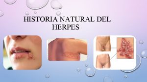 HISTORIA NATURAL DEL HERPES AGENTE VHS 1 HERPES