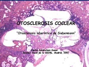 Signo de schwartze otosclerosis
