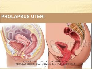 Grade prolaps uteri