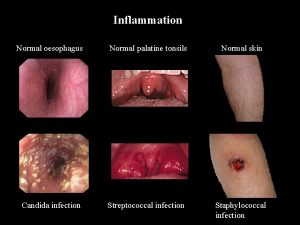 Inflammation Normal oesophagus Normal palatine tonsils Normal skin