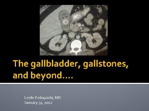 The gallbladder gallstones and beyond Leslie Kobayashi MD