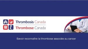 Savoir reconnatre la thrombose associe au cancer Divulgation