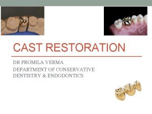 Cast restoration definition