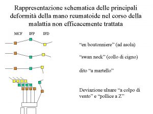 Rappresentazione schematica delle principali deformit della mano reumatoide