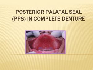 POSTERIOR PALATAL SEAL PPS IN COMPLETE DENTURE POSTERIOR
