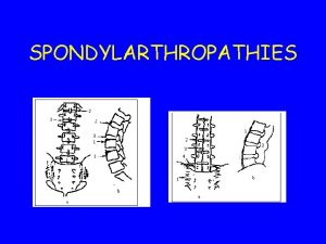 SPONDYLARTHROPATHIES SPONDYLARTHROPATHIES 1 Atteinte articulaire axiale 2 Atteinte