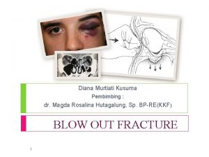 Impure blowout fracture