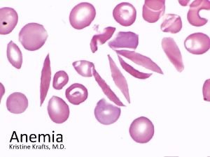 Aplastic anemia