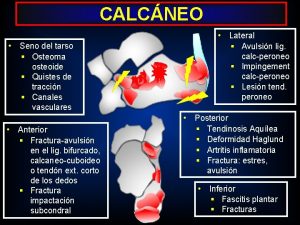 Avulsion astragalo