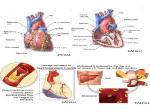 Coronary heart disease CHD is a narrowing of