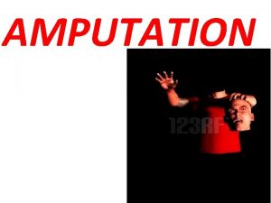 Chopart amputation Chopart amputation