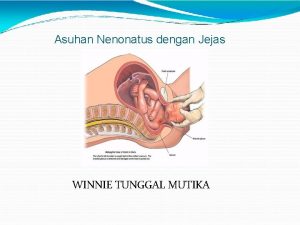 Asuhan Nenonatus dengan Jejas Persalinan WINNIE TUNGGAL MUTIKA