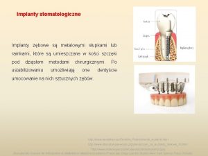 Implanty stomatologiczne Implanty zbowe s metalowymi supkami lub