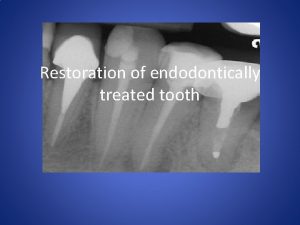 Restoration of endodontically treated tooth Amalgam resin composite