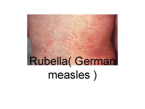 Rubella