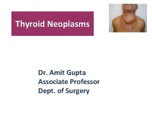 Thyroid Neoplasms Dr Amit Gupta Associate Professor Dept