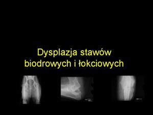 Dysplazja staww biodrowych i okciowych Dysplazja Dys anormalny