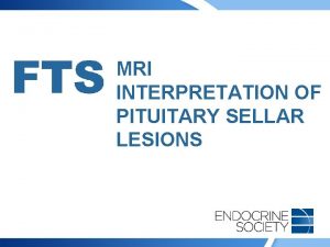 MRI INTERPRETATION OF PITUITARY SELLAR LESIONS Pituitary MRI