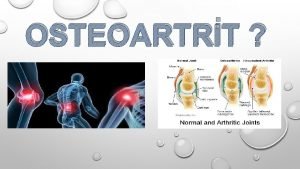 OSTEOARTRT OSTEOARTRTKRELEN ME Dejeneratif eklem hastal olan osteoartrit