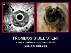 TROMBOSIS DEL STENT Clinica cardiovascular Santa Maria Medellin