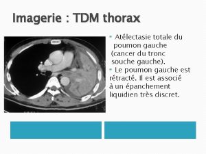 Imagerie TDM thorax Atlectasie totale du poumon gauche