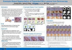 ExemplarBased Segmentation of Pigmented Skin Lesions from Dermoscopy