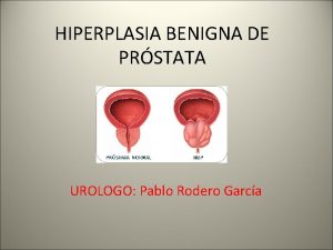 HIPERPLASIA BENIGNA DE PRSTATA UROLOGO Pablo Rodero Garca