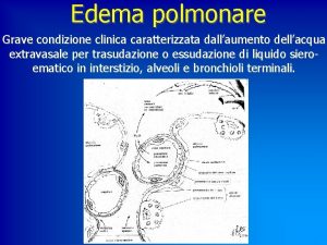 Edema polmonare Grave condizione clinica caratterizzata dallaumento dellacqua