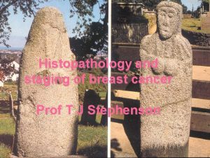 Histopathology and staging of breast cancer Prof T
