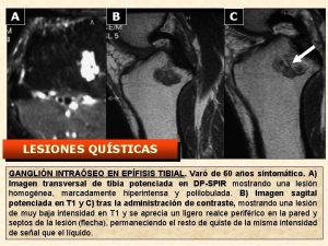 A B C LESIONES QUSTICAS GANGLIN INTRASEO EN