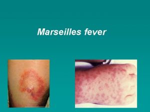 Marseilles fever Marseilles fever a disease common in