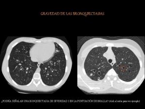 GRAVEDAD DE LAS BRONQUIECTASIAS PODRA SEALAR UNA BONQUIECTASIA